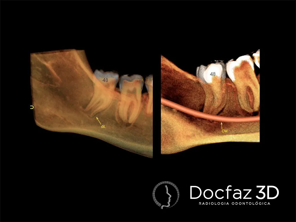 Imagem tomográfica ilustrativa — Cirurgia Buco Maxilo Facial