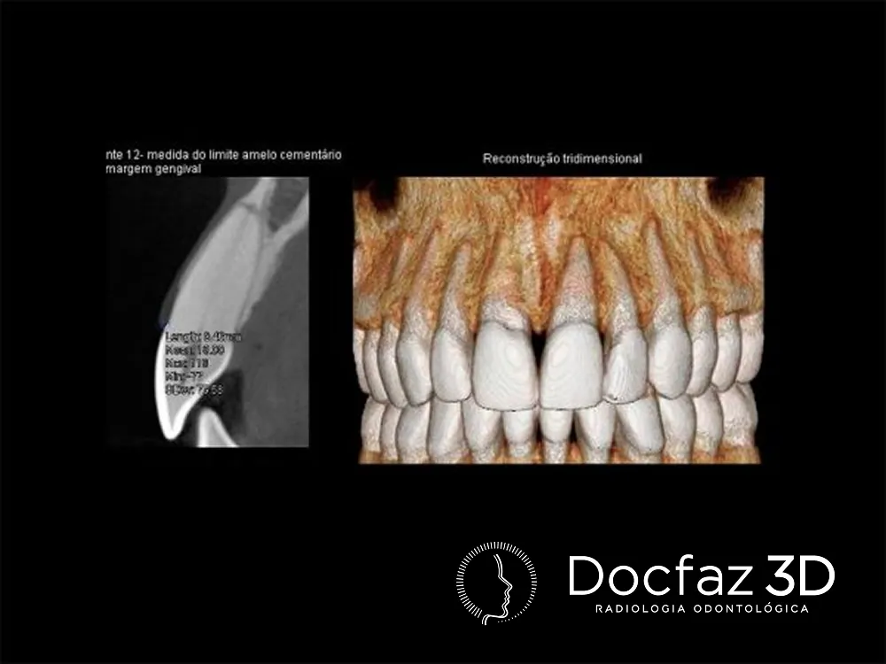 Imagem tomográfica ilustrativa — Periodontia