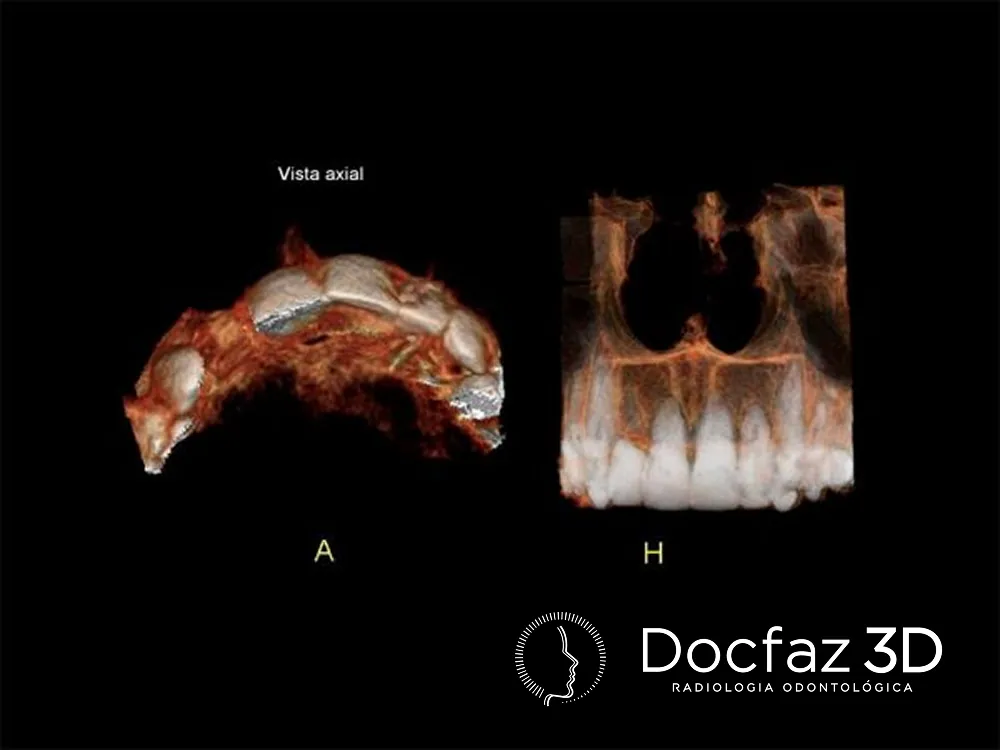 Imagem tomográfica ilustrativa — Prótese Dentária